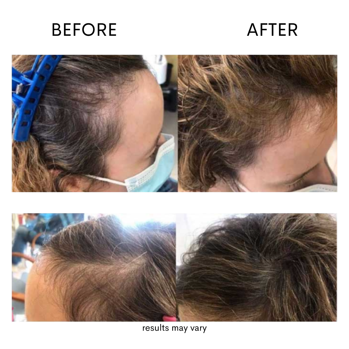 A four-panel before-and-after comparison showing the side and top of a person's scalp, with hairline thinning visible in the left 'BEFORE' panels and fuller-looking hair in the right 'AFTER' panels. Text at the bottom reads 'results may vary'.