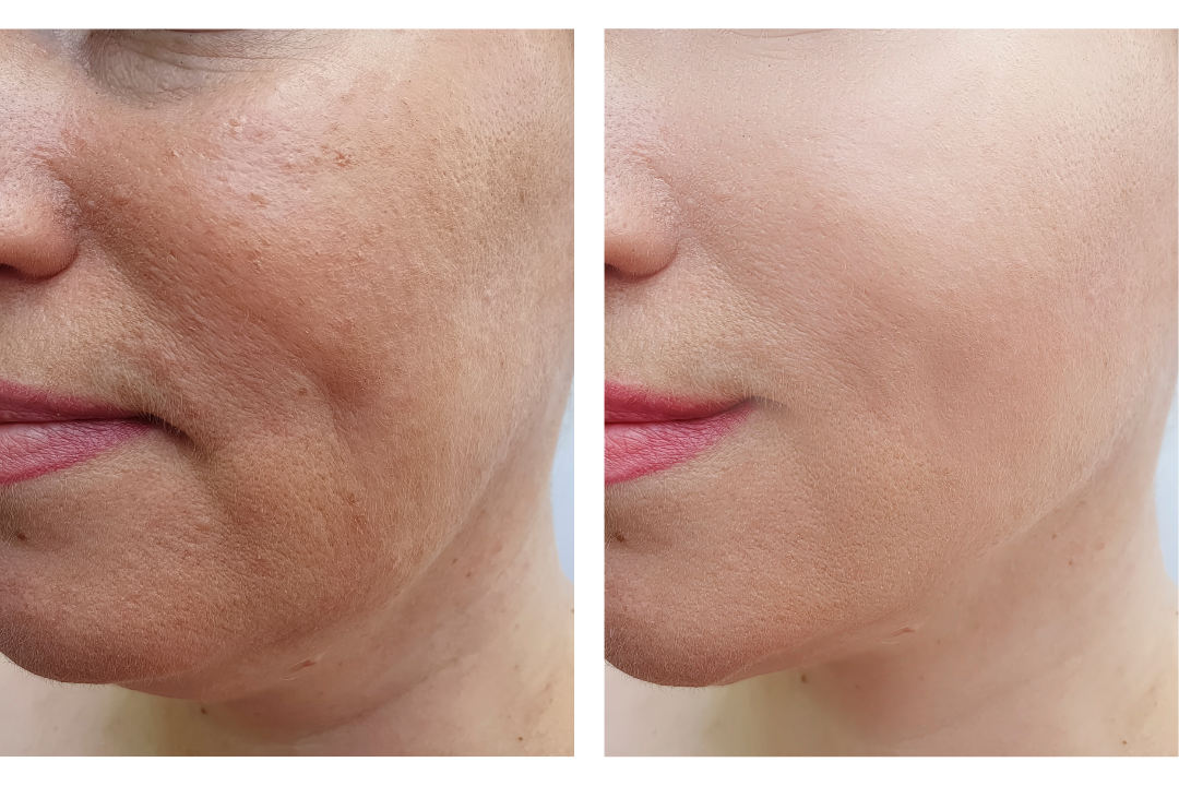 How We Can Restore Collagen To Smooth Wrinkles After 25 Years Of Age