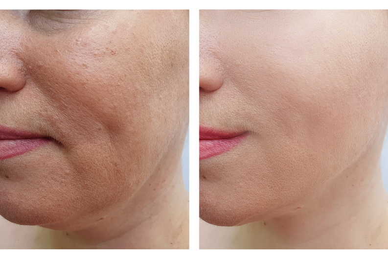 How We Can Restore Collagen To Smooth Wrinkles After 25 Years Of Age